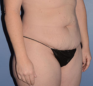 Tummy Tuck