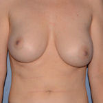 Breast Correction