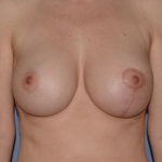 Breast Correction