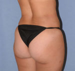 Liposuction