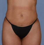 Liposuction