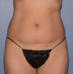 Liposuction