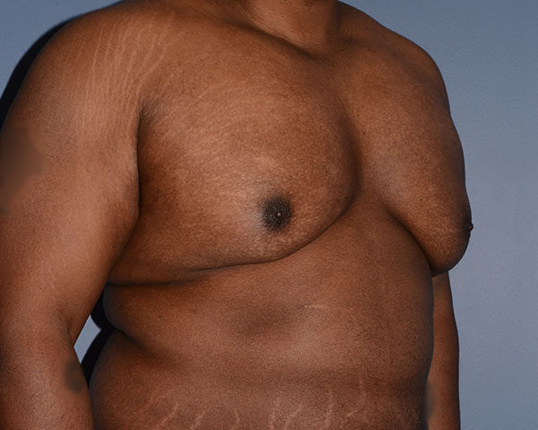 Male Breast Reduction Gynecomastia