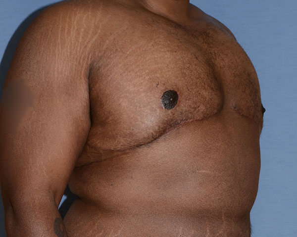 Male Breast Reduction Gynecomastia