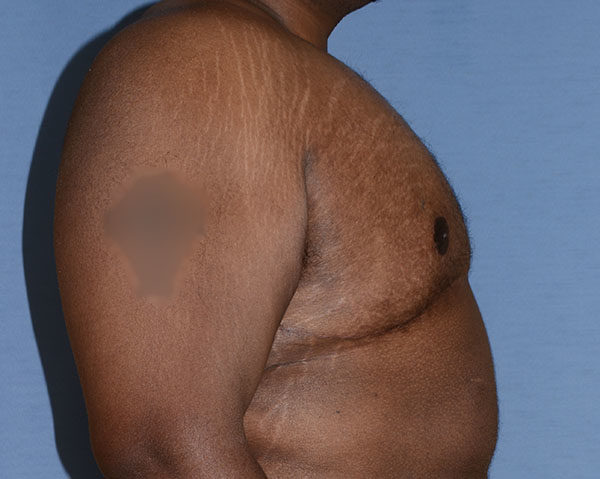 Male Breast Reduction Gynecomastia