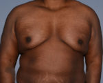 Male Breast Reduction Gynecomastia