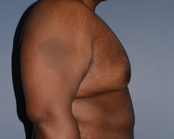 Male Breast Reduction Gynecomastia