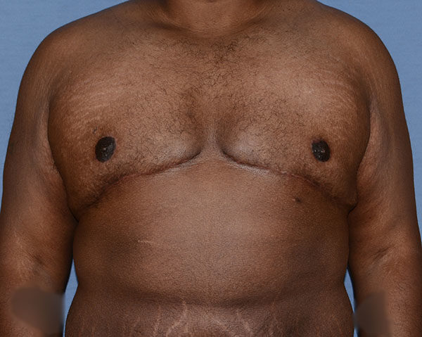 Male Breast Reduction Gynecomastia