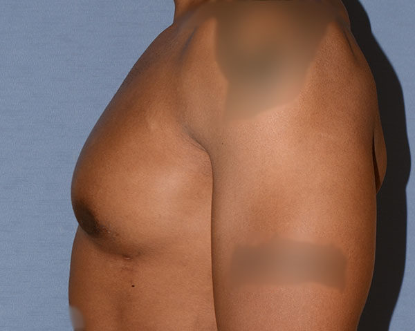 Male Breast Reduction Gynecomastia