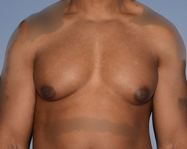 Male Breast Reduction Gynecomastia