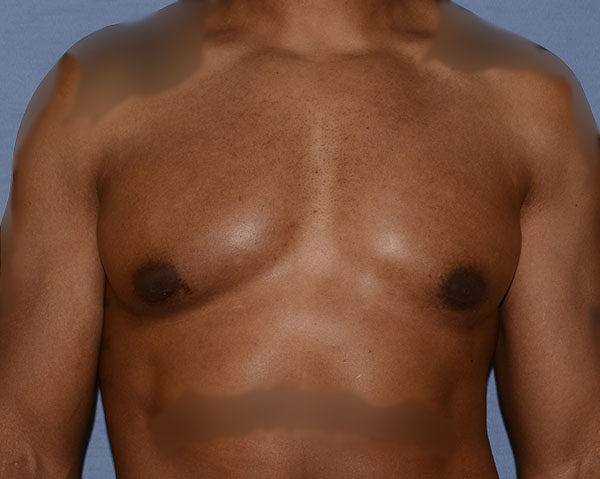 Male Breast Reduction Gynecomastia