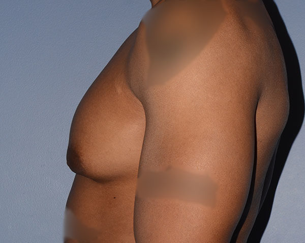 Male Breast Reduction Gynecomastia