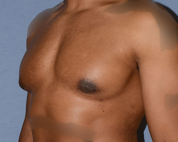 Male Breast Reduction Gynecomastia