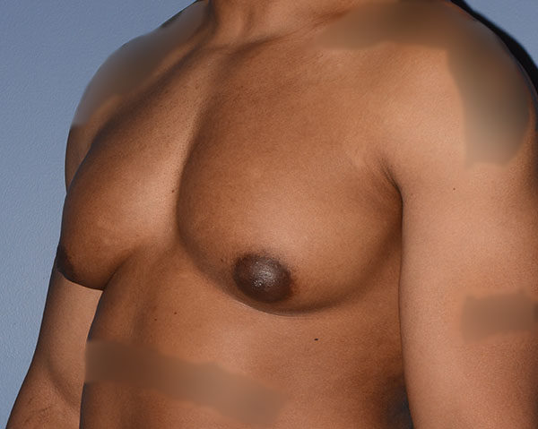 Male Breast Reduction Gynecomastia