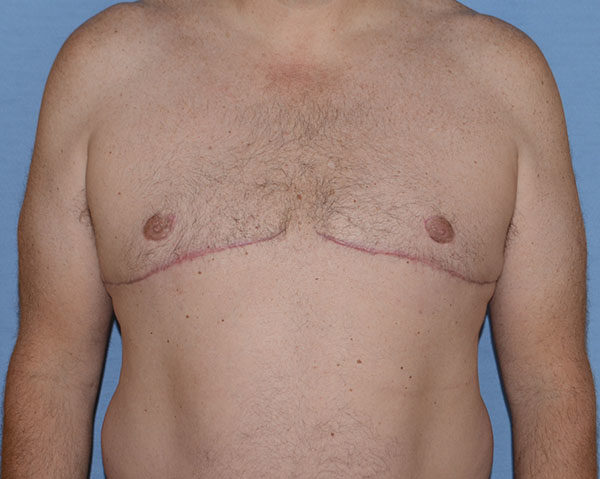 Male Breast Reduction Gynecomastia