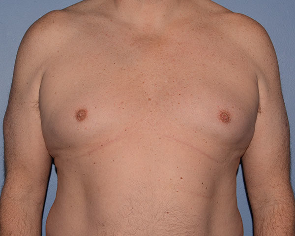 Male Breast Reduction Gynecomastia