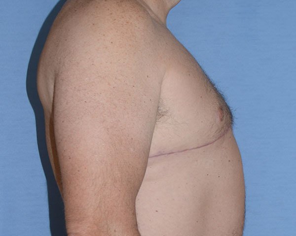 Male Breast Reduction Gynecomastia