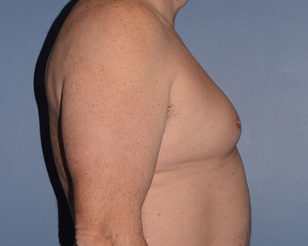 Male Breast Reduction Gynecomastia