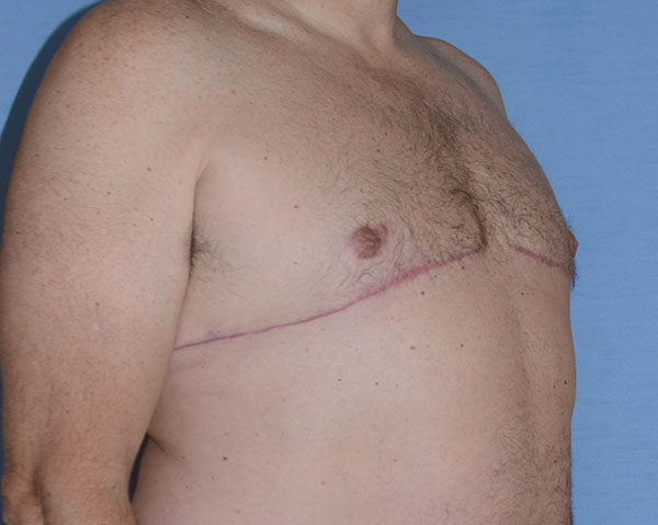 Male Breast Reduction Gynecomastia