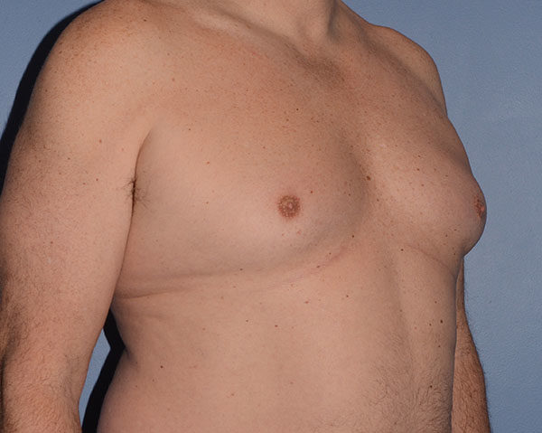 Male Breast Reduction Gynecomastia