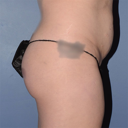 Brazilian Butt Lift
