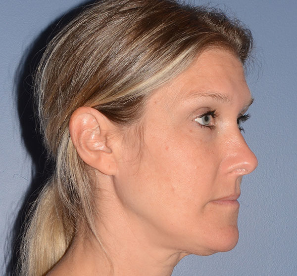 Facial Fat Transfer