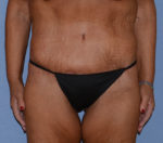 Tummy Tuck
