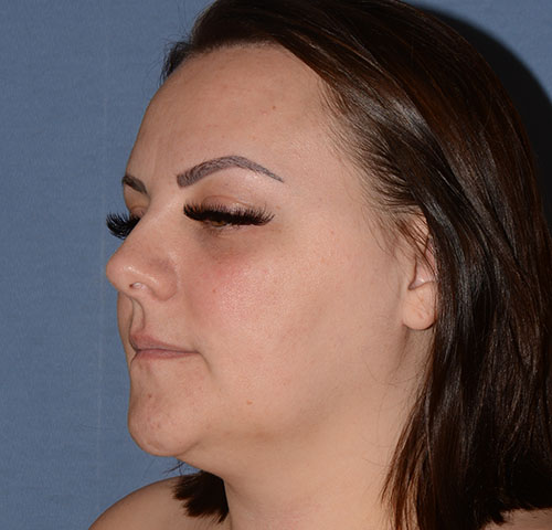 Chin and Jawline Liposuction