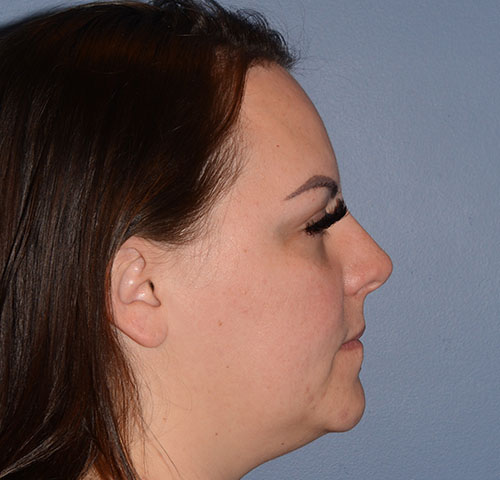 Chin and Jawline Liposuction