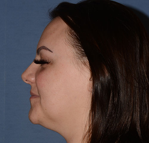 Chin and Jawline Liposuction