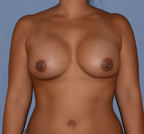 Breast Augmentation Implants