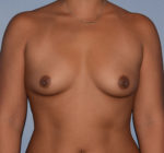 Breast Augmentation Implants