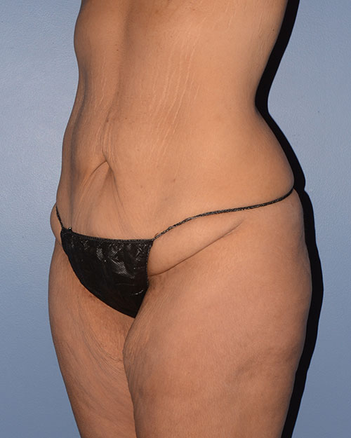 Tummy Tuck