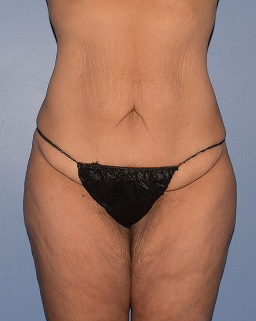 Tummy Tuck