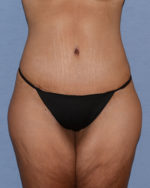 Tummy Tuck