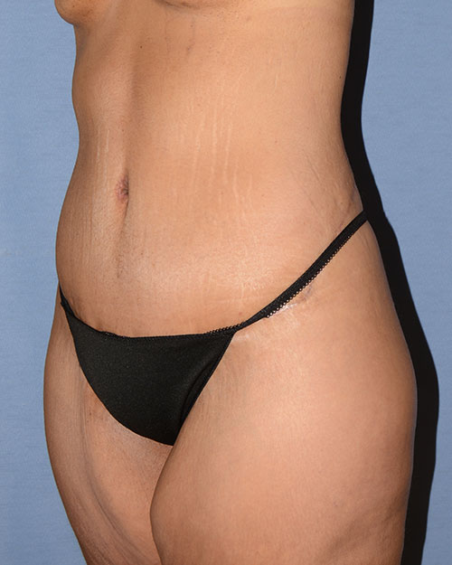 Tummy Tuck