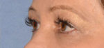 Eyelid Lift