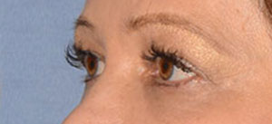 Eyelid Lift