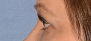 Eyelid Lift