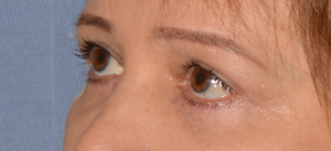 Eyelid Lift