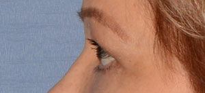 Eyelid Lift