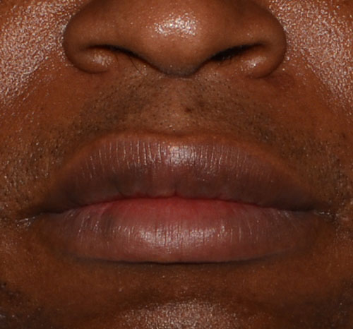 Lip Reduction