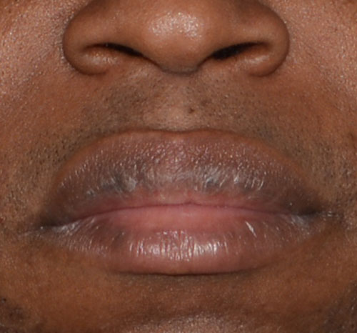 Lip Reduction