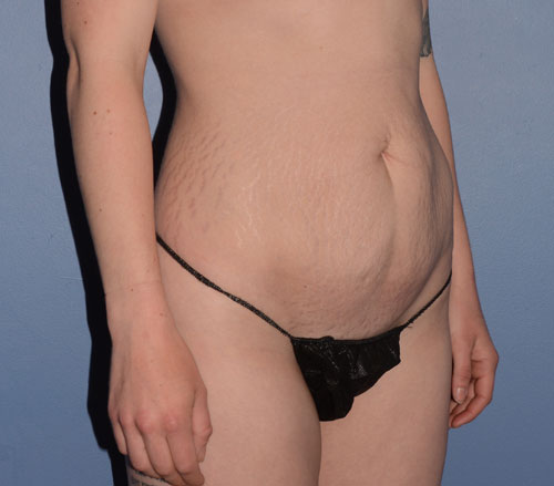 Tummy Tuck