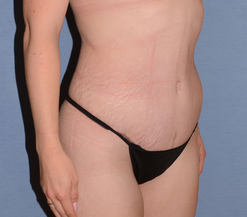Tummy Tuck
