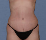 Tummy Tuck