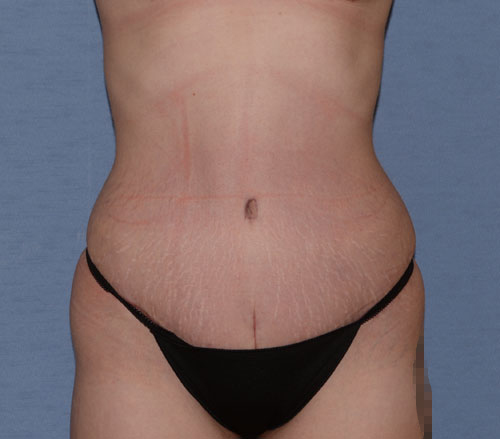 Tummy Tuck