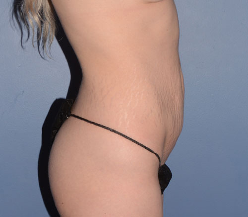 Tummy Tuck
