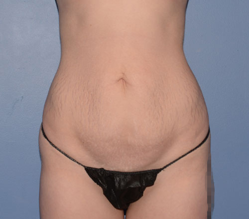 Tummy Tuck