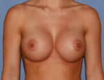 Breast Augmentation Implants